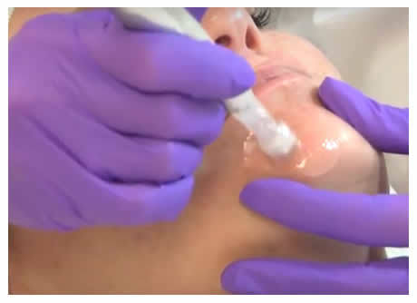 Nuove tecniche di ringiovanimento viso microneedling | Grandi Sconti | Estetista di Bellezza e Massaggi Olena Esthetics