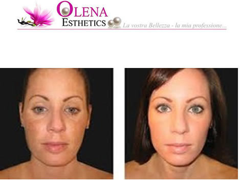 peeling viso estetista